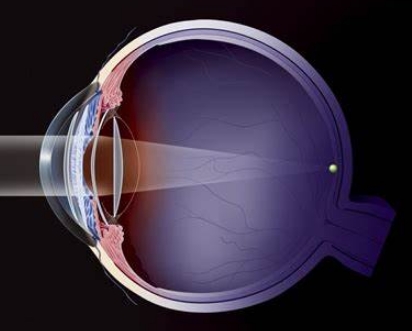 眼科醫(yī)療的未來：揭秘多焦點(diǎn)人工晶狀體的創(chuàng)新設(shè)計