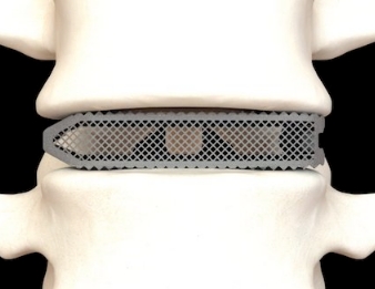 個性化脊柱治療的利器：3D打印脊柱植入物的技術(shù)進(jìn)展