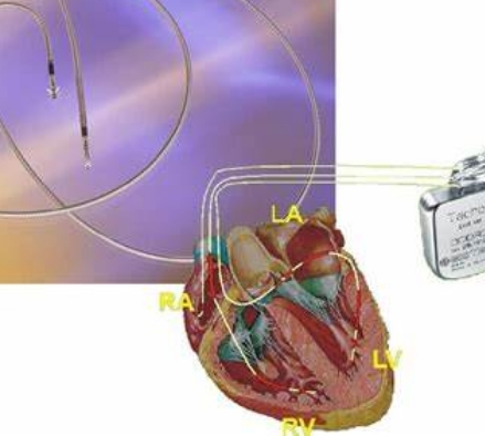 心臟起搏器技術進步：更長壽、更健康的未來