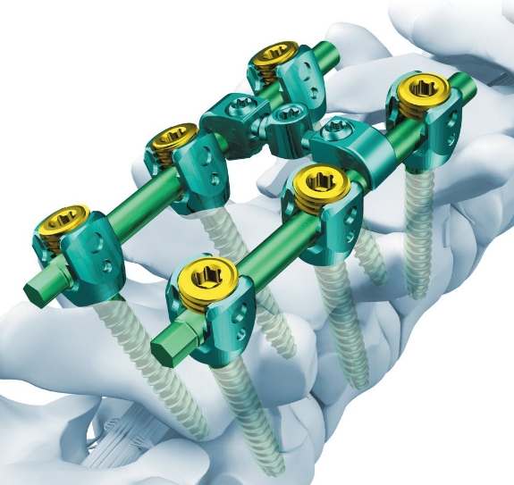 脊柱固定系統(tǒng)：穩(wěn)定脊柱，緩解疼痛——脊柱固定系統(tǒng)的設(shè)計與實施要點